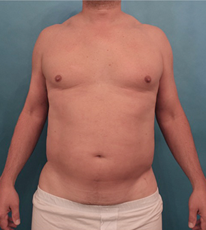 Body Contouring Kybella Patient #1 Before Photo Thumbnail # 1
