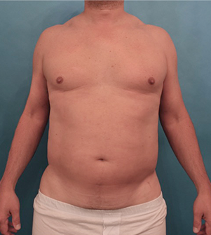 Before Image: Body Contouring Kybella Patient #1 - 