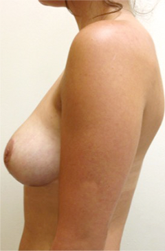 Breast Lift Patient #1 After Photo # 4