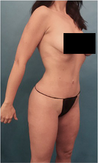 Brazilian Butt Lift Patient #4 After Photo # 6