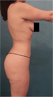After Image: Liposuction Patient #15 - 