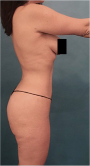 Liposuction Patient #15 After Photo # 10