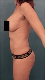 Brazilian Butt Lift Patient #3 After Photo Thumbnail # 2