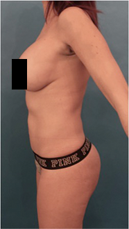 Brazilian Butt Lift Patient #3 After Photo # 2