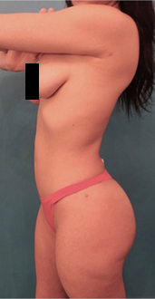 Liposuction Patient #14 After Photo # 4