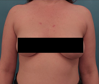 Before Image: Body Contouring Kybella Patient #2 - 