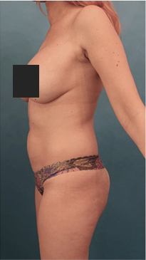 Liposuction Patient #16 Before Photo # 5