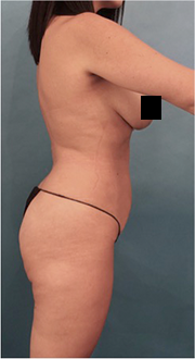 Brazilian Butt Lift Patient #4 Before Photo Thumbnail # 7