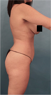 Brazilian Butt Lift Patient #4 Before Photo # 7