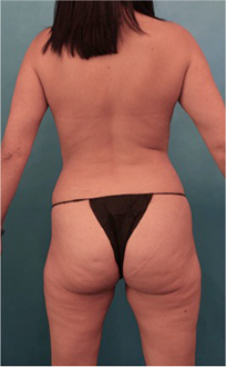 Before Image: Liposuction Patient #15 - 