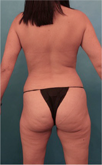 Liposuction Patient #15 Before Photo # 11