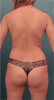 Brazilian Butt Lift Patient #3 Before Photo # 5