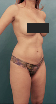 Liposuction Patient #16 Before Photo Thumbnail # 7