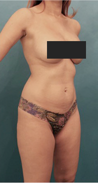 Liposuction Patient #16 Before Photo # 7