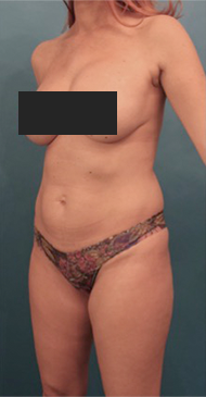 Liposuction Patient #16 Before Photo # 3