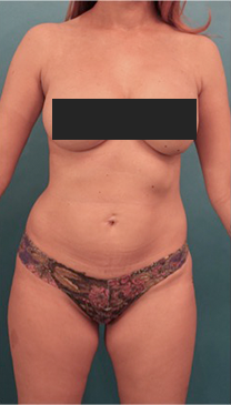 Liposuction Patient