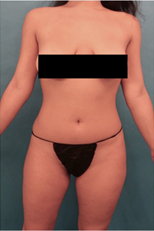 Liposuction Patient