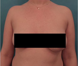 Body Contouring Kybella Patient #2 After Photo # 2