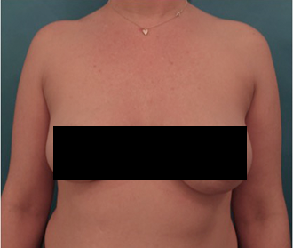 After Image: Body Contouring Kybella Patient #2 - 