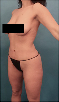 After Image: Liposuction Patient #15 - 