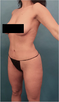 Liposuction Patient #15 After Photo # 4