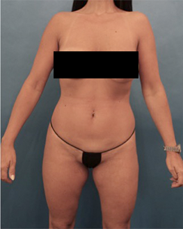 Before Image: Liposuction Patient #15 - 