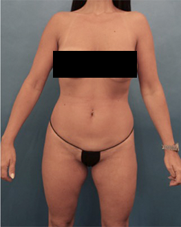 Liposuction Patient