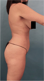 Liposuction Patient #15 Before Photo # 9