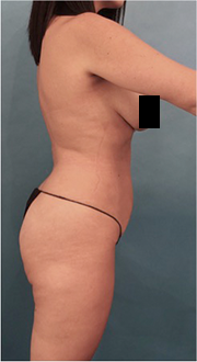Before Image: Liposuction Patient #15 - 