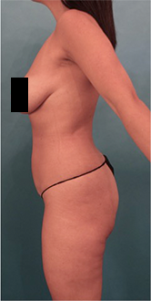 Before Image: Liposuction Patient #15 - 