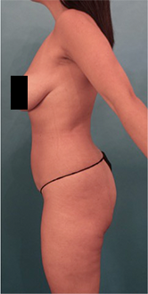 Liposuction Patient #15 Before Photo # 5