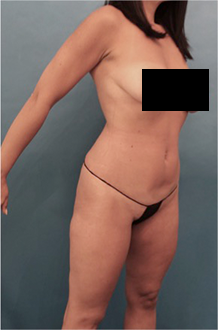 Liposuction Patient #15 Before Photo # 7