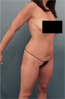 Before Image: Liposuction Patient #15 - 