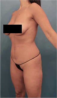 Before Image: Liposuction Patient #15 - 