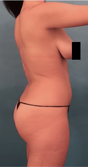 Liposuction Patient #14 Before Photo # 13