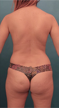 Liposuction Patient #16 Before Photo # 11