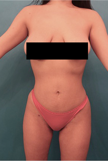 Liposuction Patient #14 After Photo Thumbnail # 2