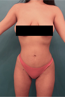 Liposuction Patient