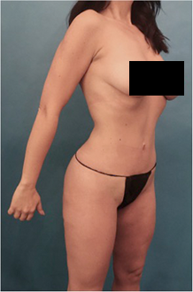 Liposuction Patient #15 After Photo # 8