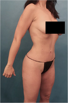 After Image: Liposuction Patient #15 - 