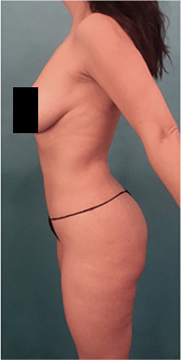 After Image: Liposuction Patient #15 - 