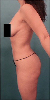 Liposuction Patient #15 After Photo # 6