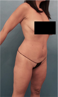 Brazilian Butt Lift Patient #4 Before Photo # 5