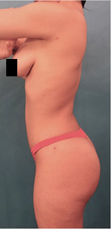 Liposuction Patient #14 After Photo # 6