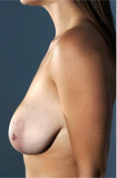 Breast Reduction Patient #1 Before Photo # 3