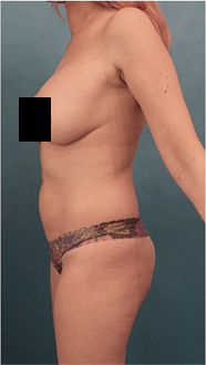 Brazilian Butt Lift Patient #3 Before Photo # 1