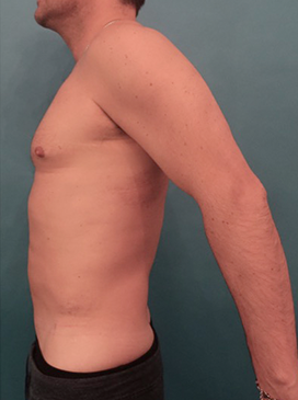 Body Contouring Kybella Patient #1 After Photo # 6