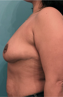Breast Reduction Patient #3 After Photo # 10