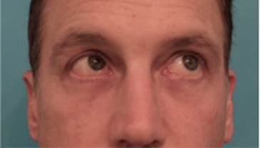 Male Blepharoplasty Patient #1 After Photo Thumbnail # 10