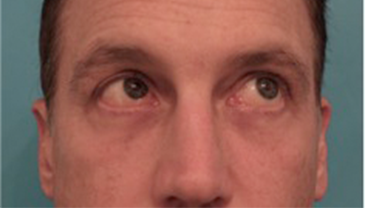 Male Blepharoplasty Patient #1 After Photo # 10